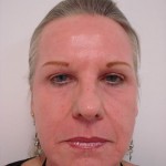 Photo taken after the CO2 Laser procedure.