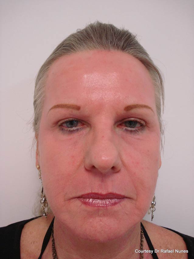 Will Lasers Replace Plastic Surgery in the Near Future?