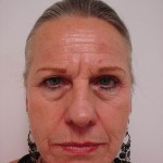 Photo taken before the CO2 Laser procedure